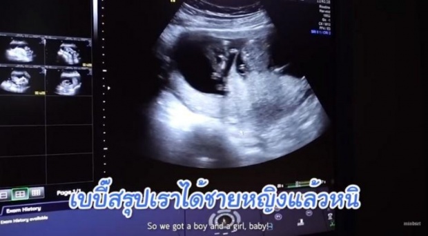 เฉลยแล้ว! เพศลูกฝาแฝดหมื่นล้าน ป๊อก มาร์กี้ สมใจพ่อแม่มือใหม่สุดๆ! (คลิป)