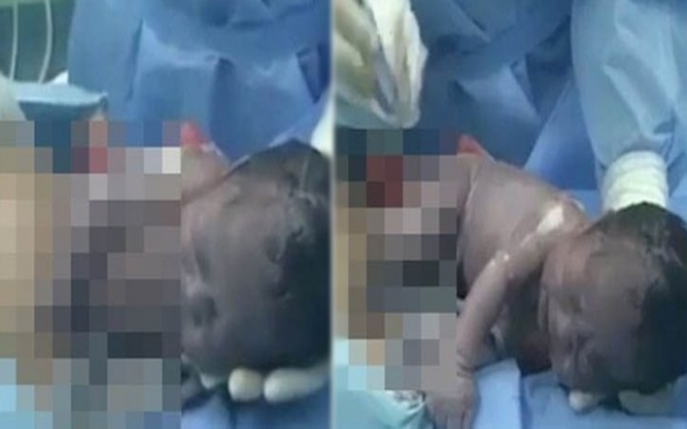 เหลือเชื่อ!! “ทารกน้อย” ใช้แขนและขาดันตัวเองออกมาจากท้องแม่ โดยที่แพทย์ไม่ได้ช่วยแต่อย่างใด (คลิป)
