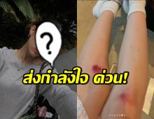 ส่งกำลังใจ นักแสดงสาวหน้านิ่ง เกิดอุบัติเหตุขณะเที่ยวทริปสิงคโปร์